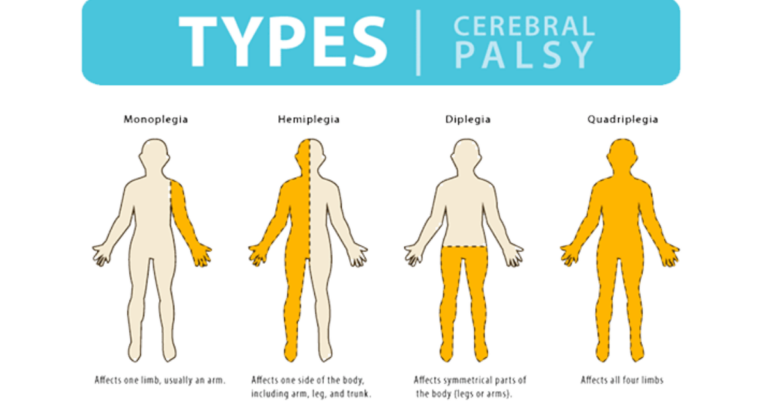 Cerebral Palsy Stem Cell Therapy in India